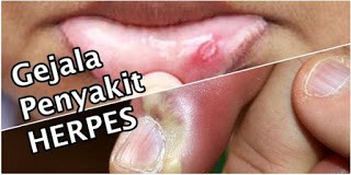 Illustration for article titled Obat herpes alami manjur